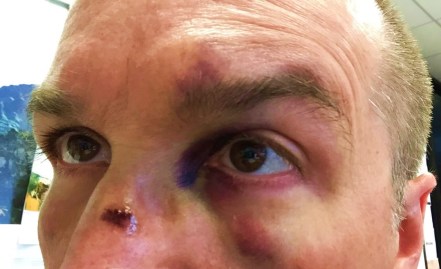 The author and his broken face.